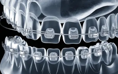 The Science of Smiles: How Braces Straighten Teeth